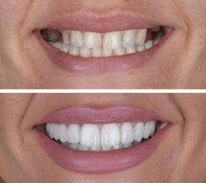 before and after teeth whitening